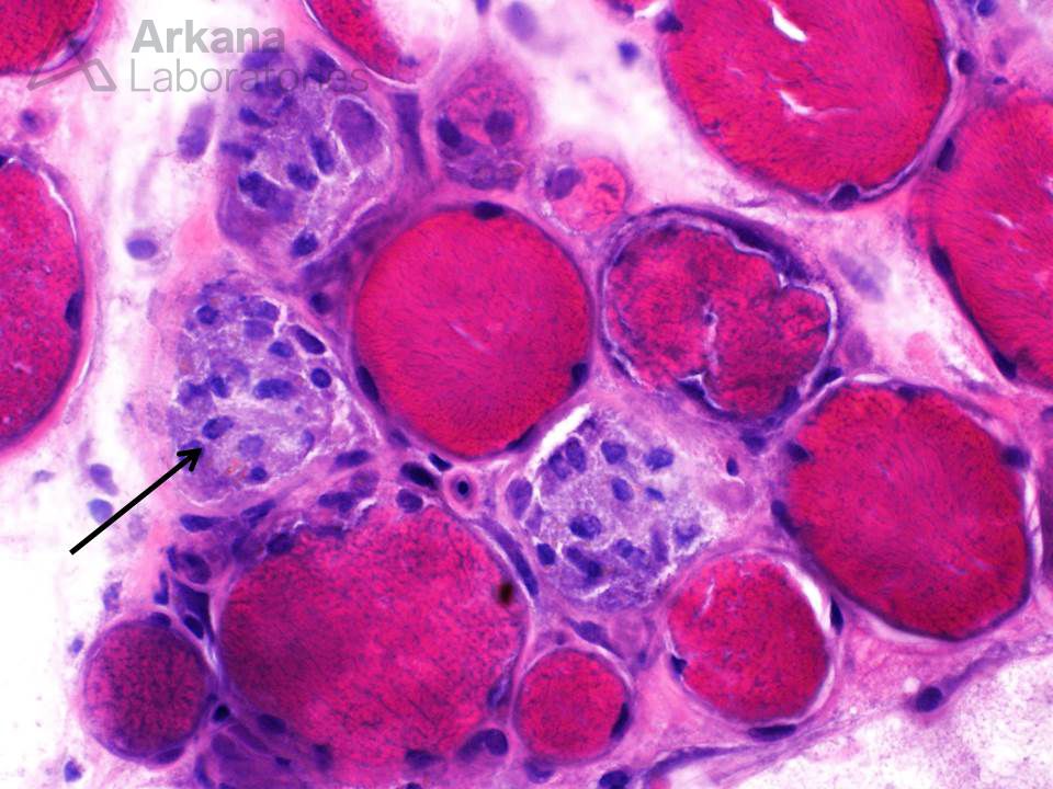 rhabdomyolysis