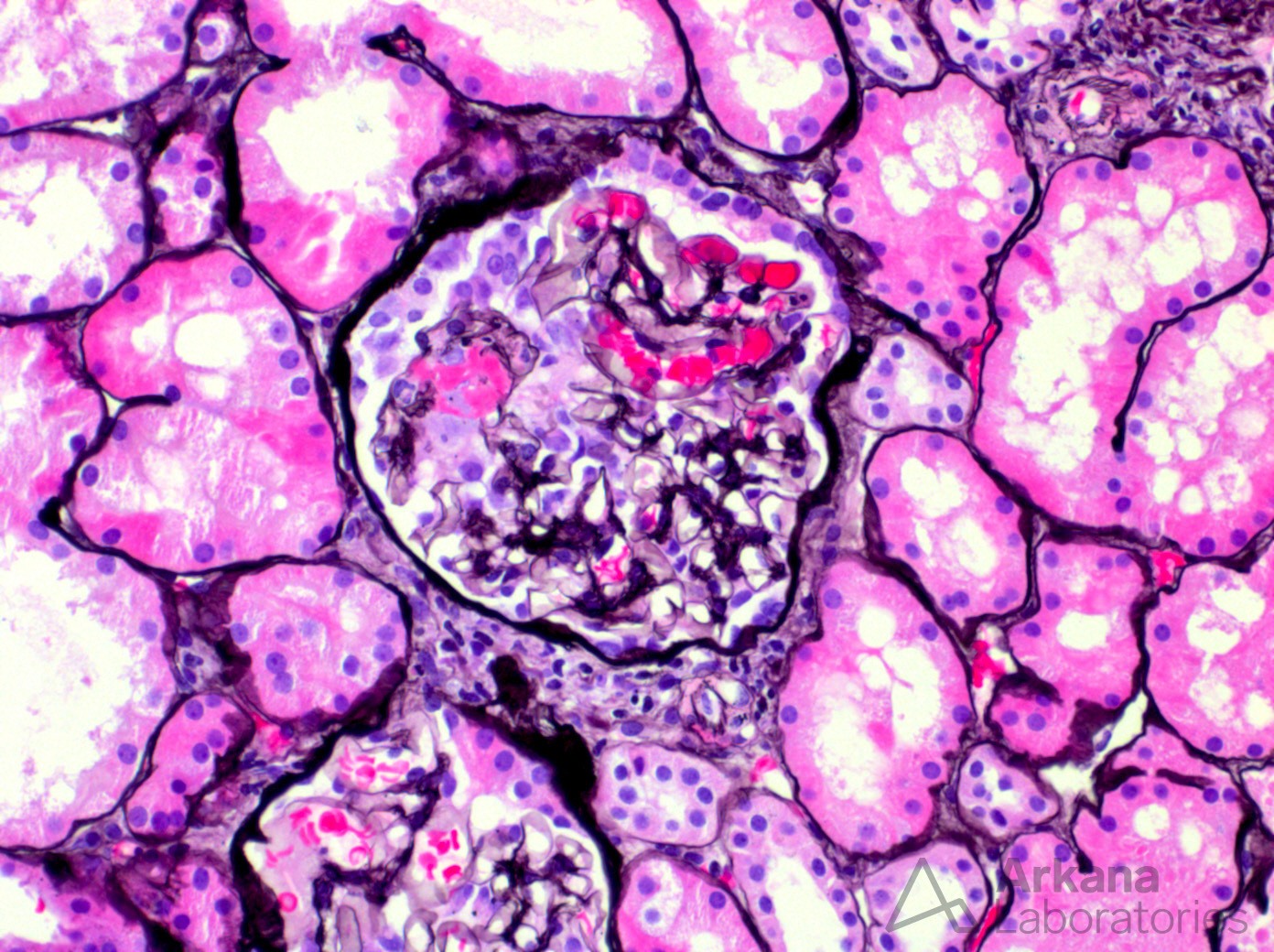 Anti-GBM, renal pathology , diagnose this!, arkana laboratories