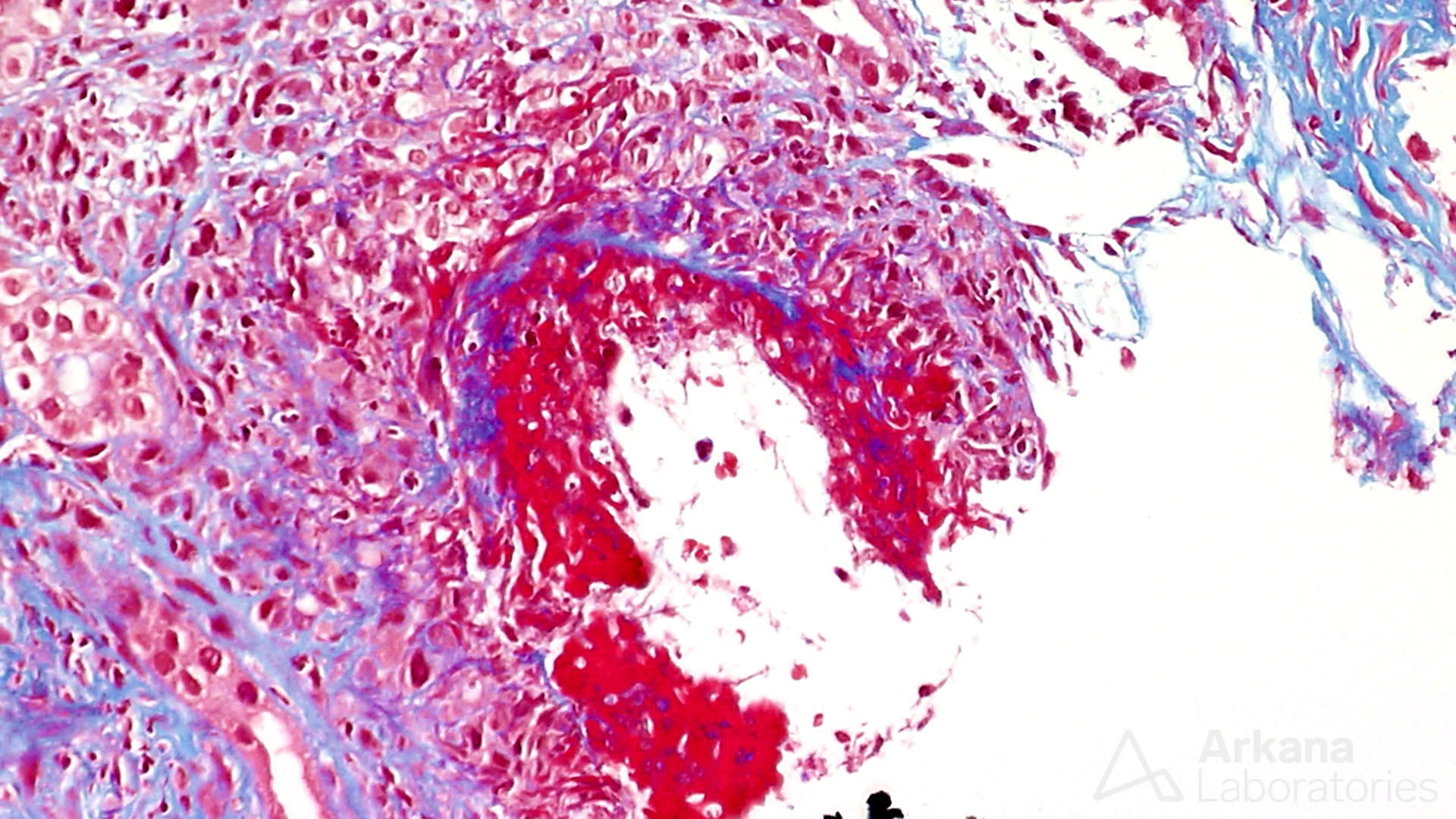 ANCA-Associated Glomerulonephritis disease