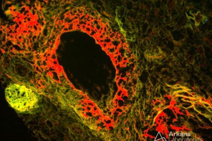 Necrotizing Vasculitis