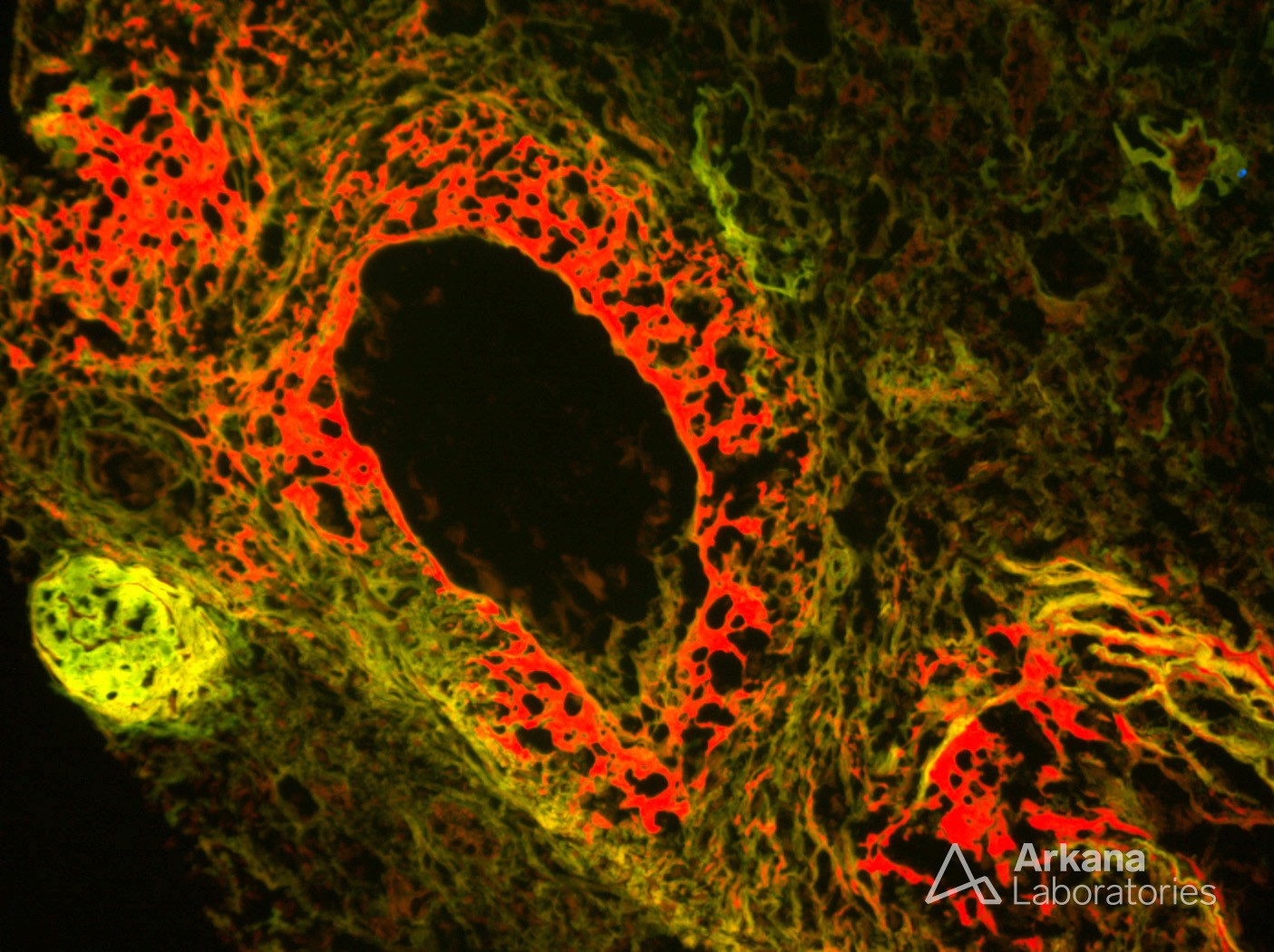 Necrotizing Vasculitis