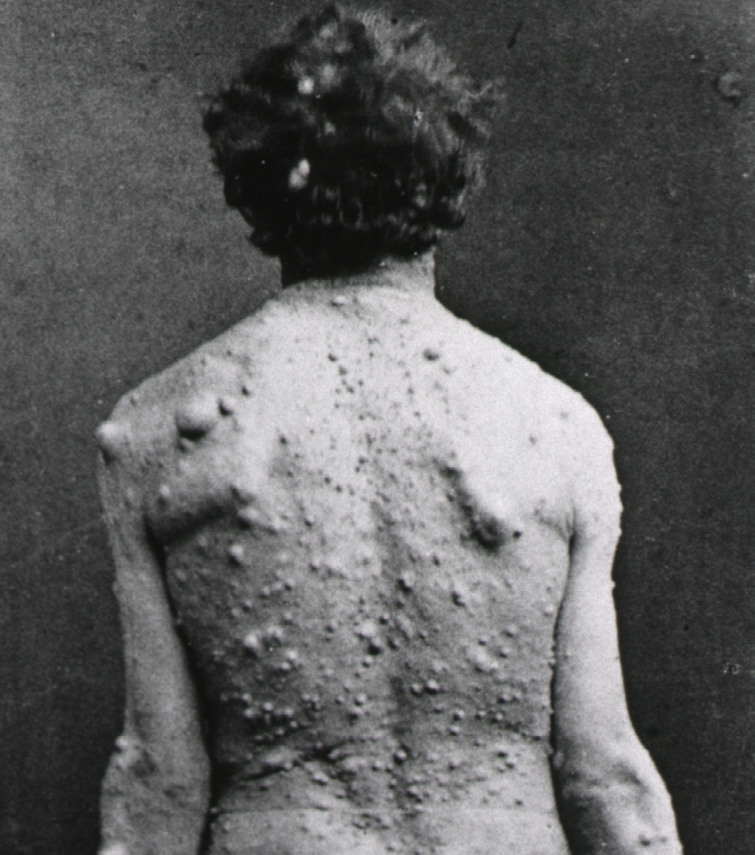 neurofibromatosis type 2 (NF2), Sclerosing Peritubular Nodule