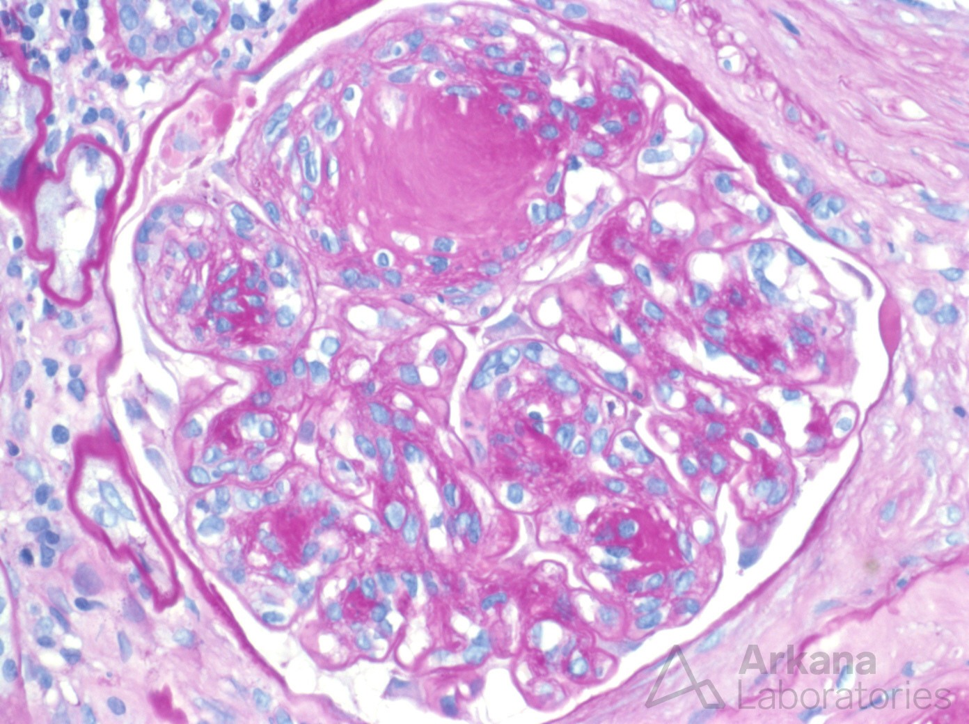 Diabetic Nephropathy imaging