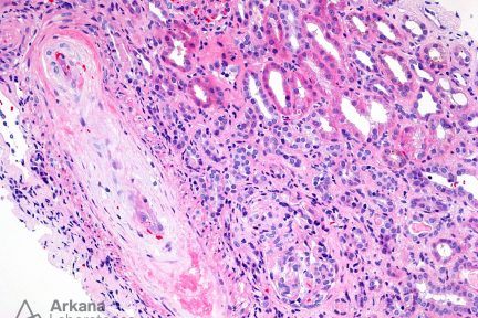 (TMA) Thrombotic Microangiopathy