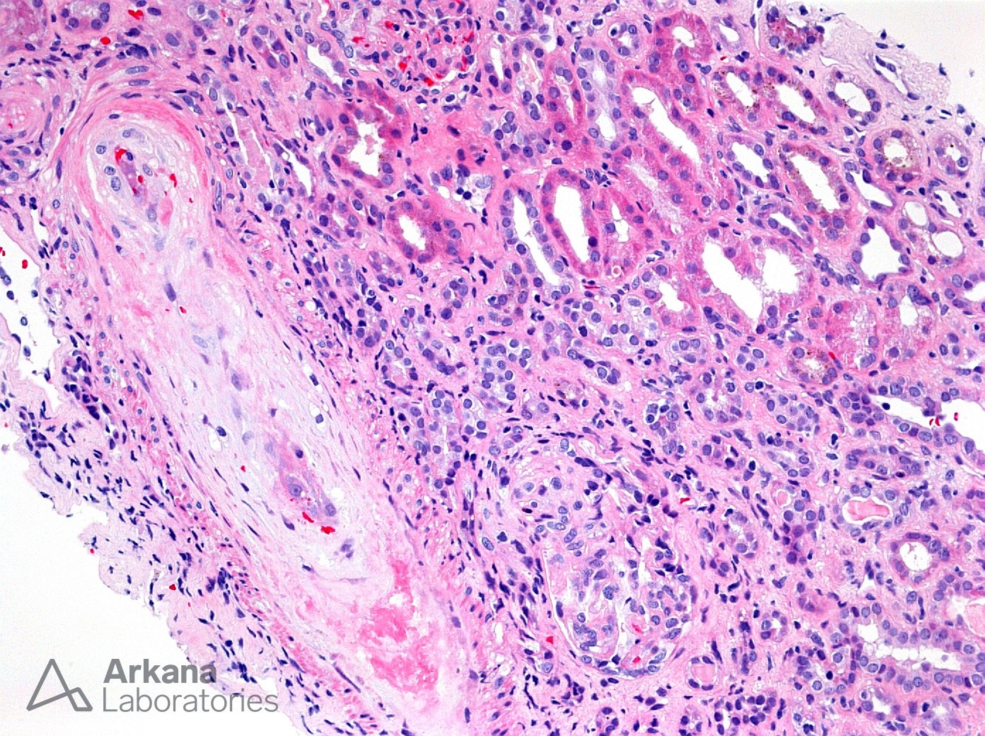 (TMA) Thrombotic Microangiopathy