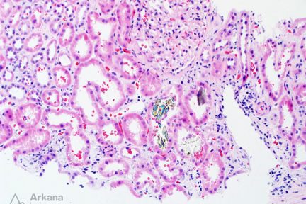 Oxalate Nephropathy