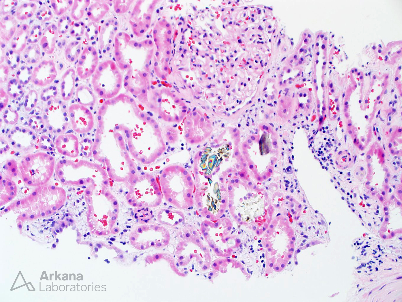 Oxalate Nephropathy