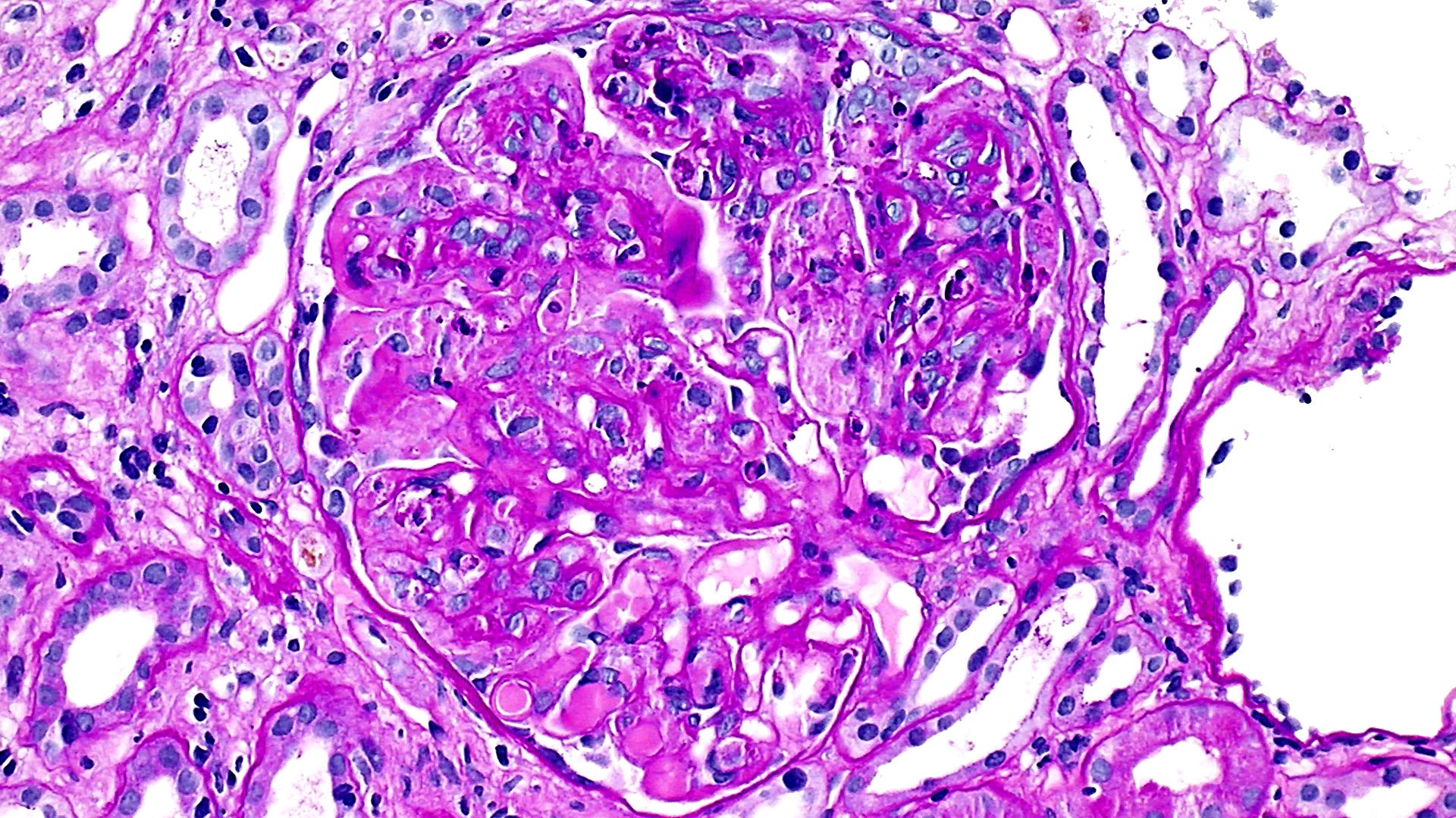 type I cryoglobulinemic glomerulonephritis