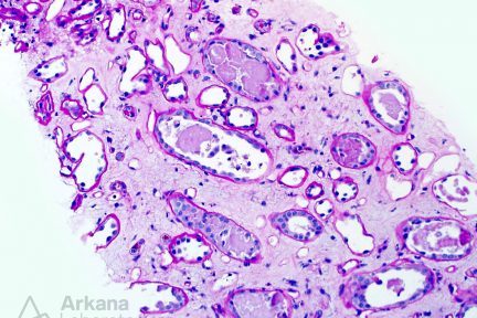Light Chain Cast Nephropathy