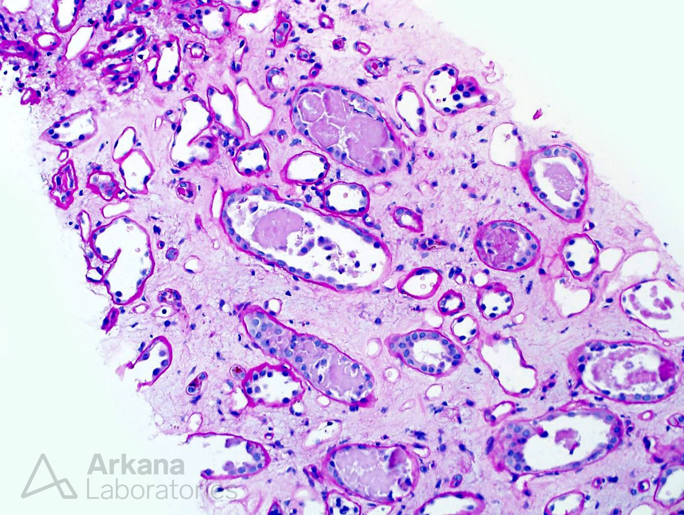 Light Chain Cast Nephropathy