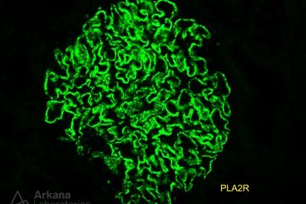 renal biopsy showing positive PLA2R stain of glomerulus