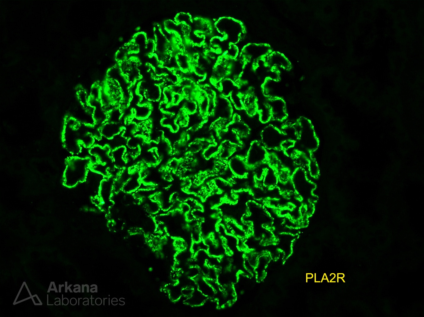 renal biopsy showing positive PLA2R stain of glomerulus