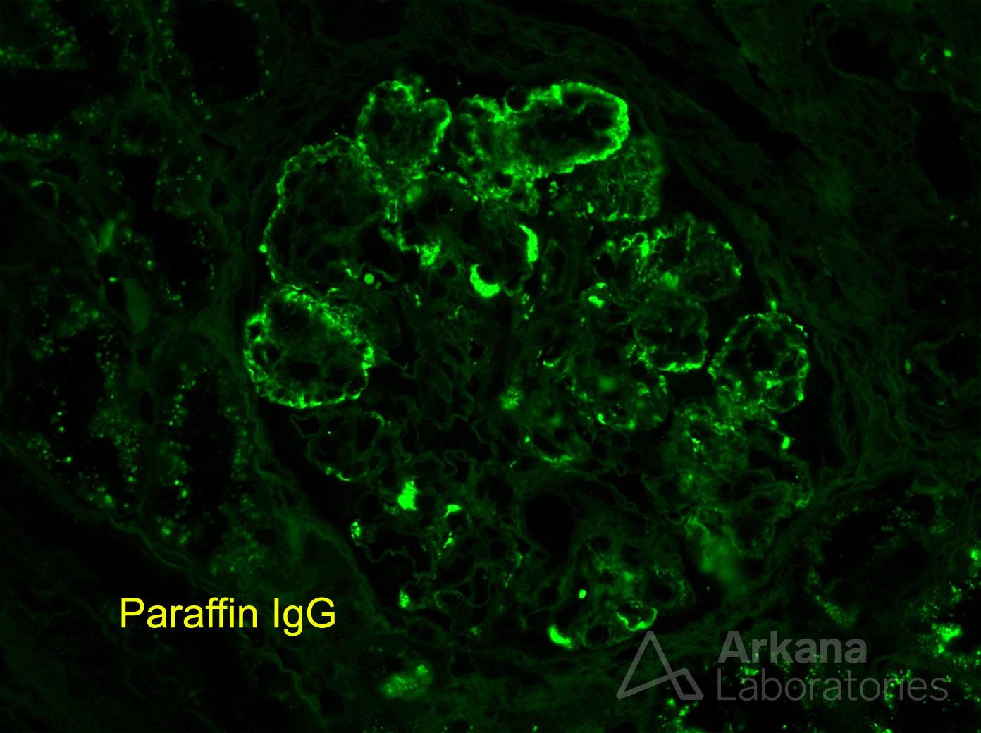 renal biopsy paraffin IgG stain showing Monoclonal gammopathy of renal significance