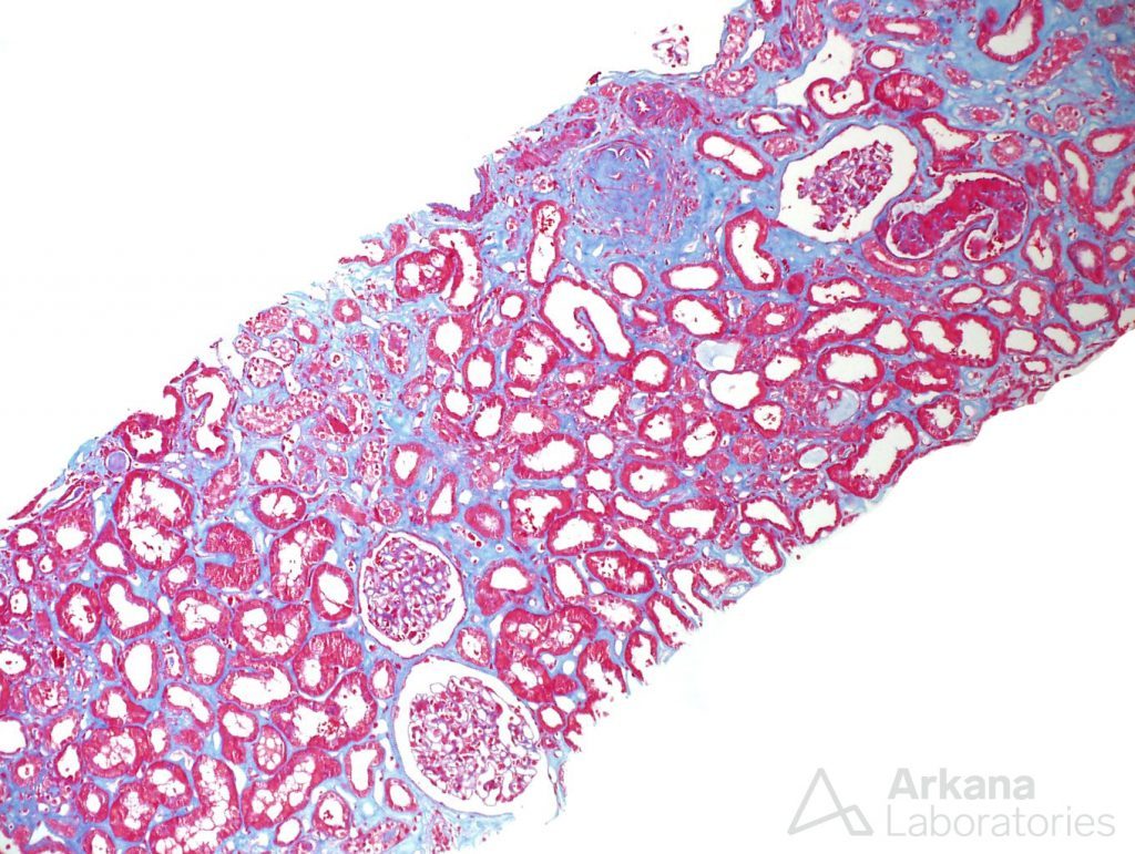 ANCA Disease, renal disease, renal cortex