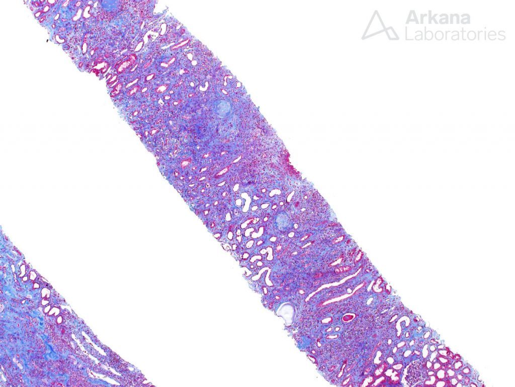 this trichrome stain revealed a mostly blue background which is indicative of widespread interstitial fibrosis