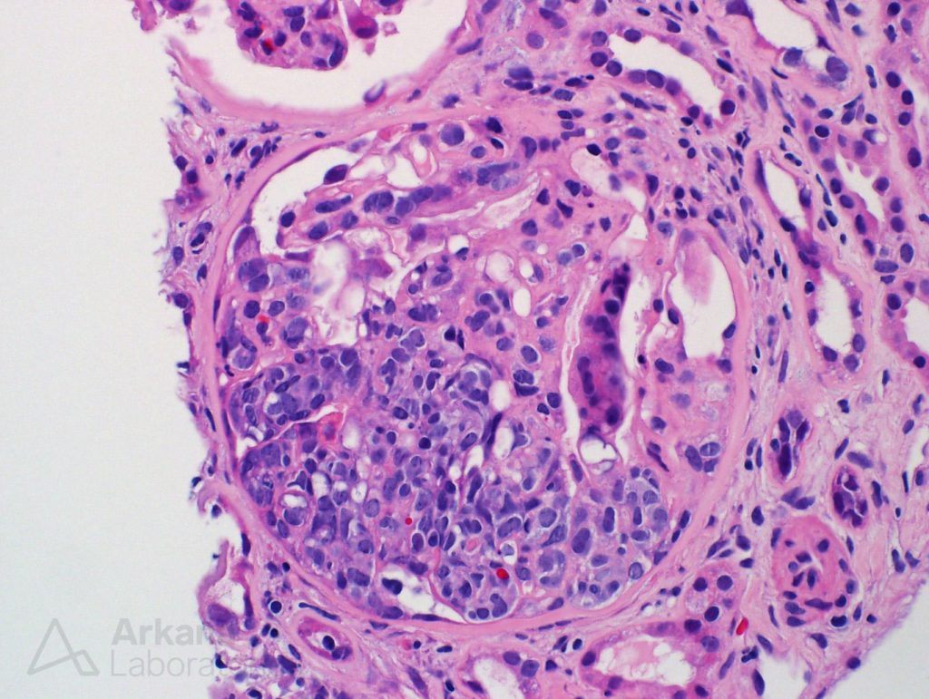 glomeruli, glomerulonephritis, membranous nephropathy, Arkana Laboratories