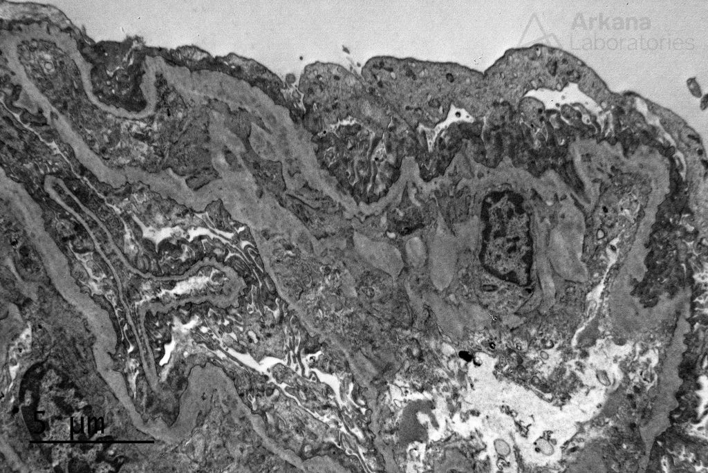 basement membranes, alport syndrome, arkana laboratories, renal pathology, nephropathology