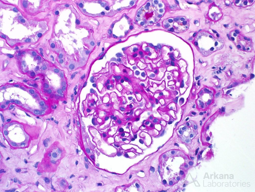 ANCA Disease, intact glomerulus