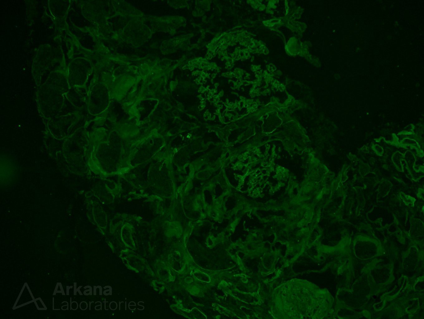 renal pathology, Arkana Laboratories, Alport syndrome