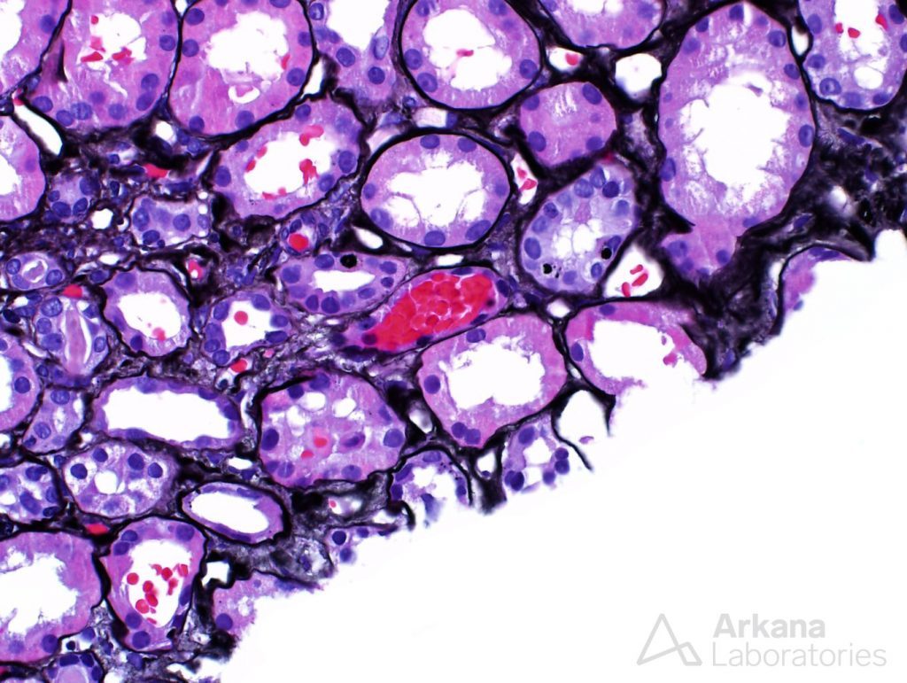 tubules were dilated and had simplified epithelium, tubular injury, ANCA Disease