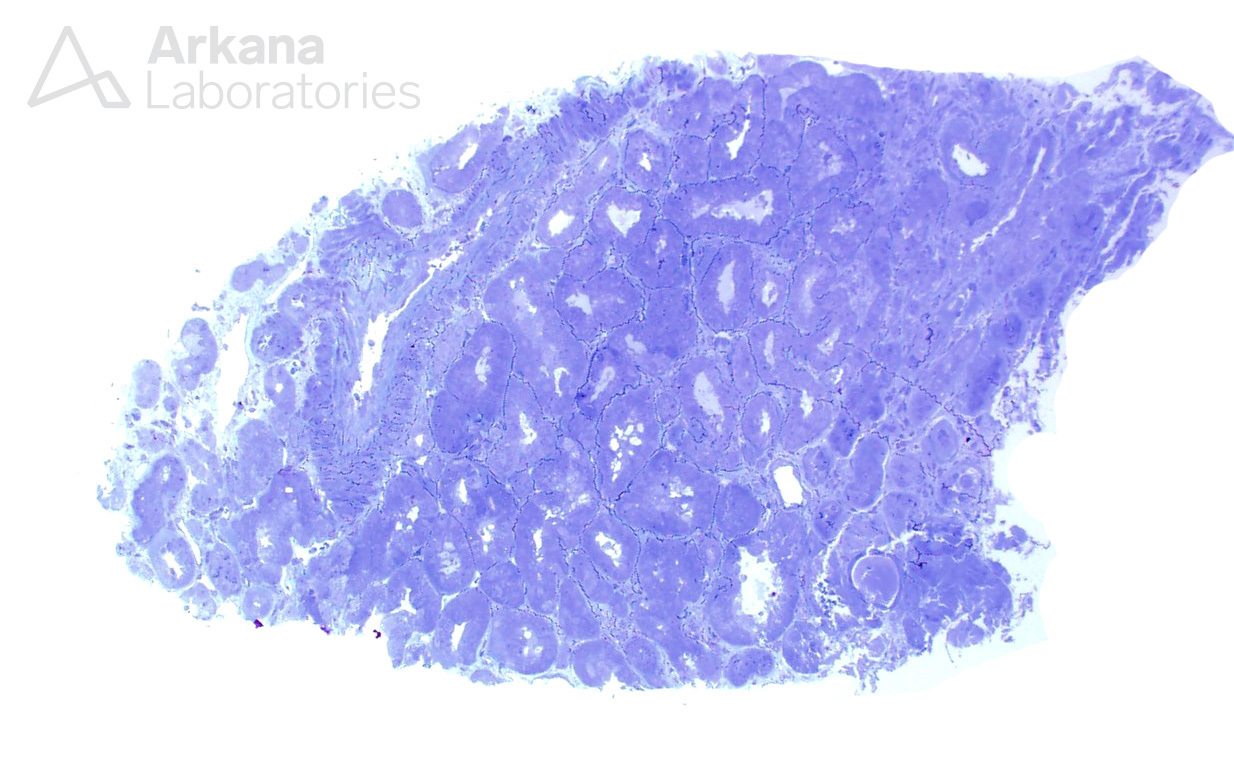 renal pathology, Arkana Laboratories, Alport syndrome