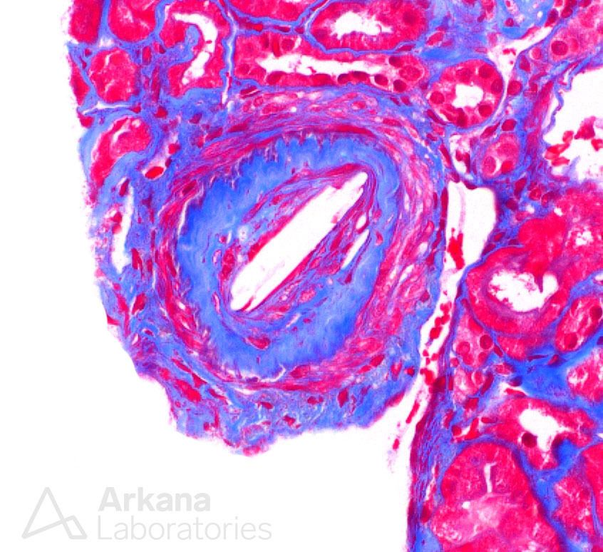LECT2 Amyloid