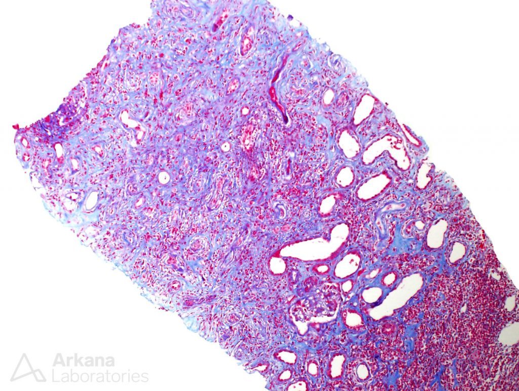 trichrome stain, IgG4-related disease