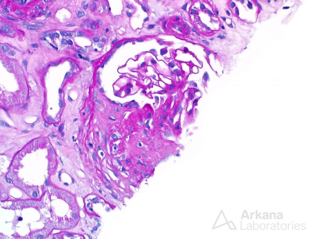fibrous crescents were identified in some glomeruli, ANCA Disease