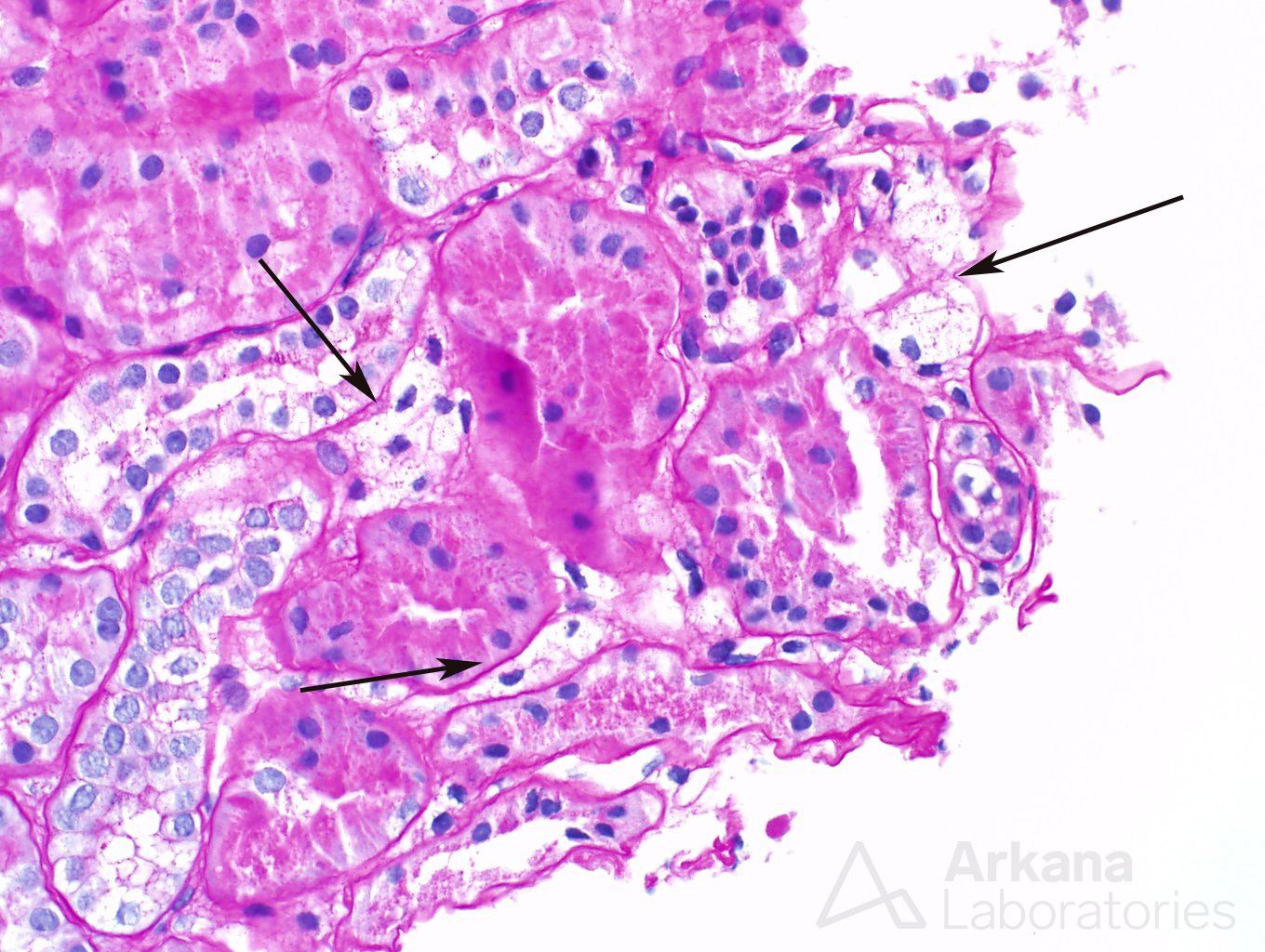 renal pathology, Arkana Laboratories, Alport syndrome