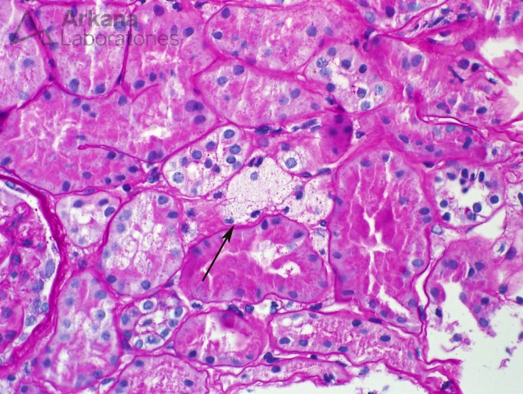 interstitial foamy cells, cortical cells, renal pathology, kidney biopsy, alport syndrome