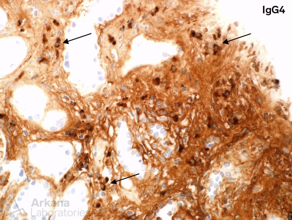 IgG4 stain, IgG4-related disease