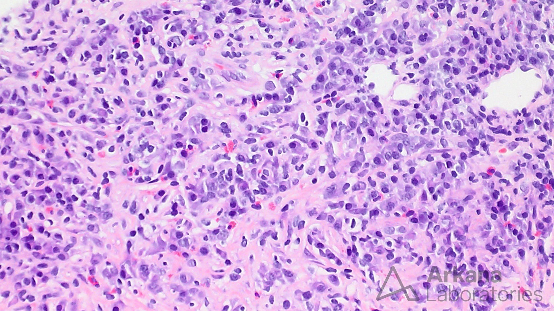 Plasma Cell Rich Interstitial Nephritis imaging