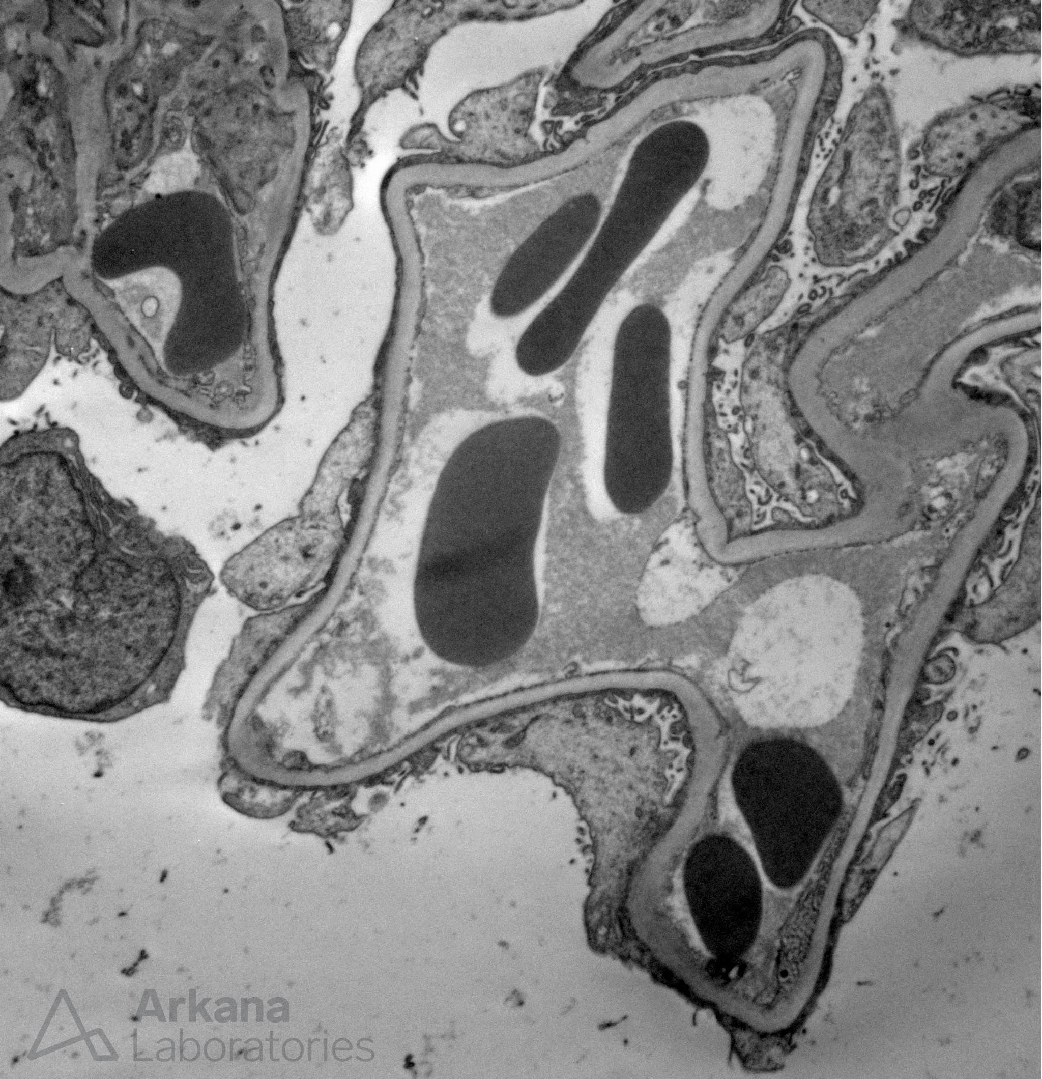 minimal change disease imaging