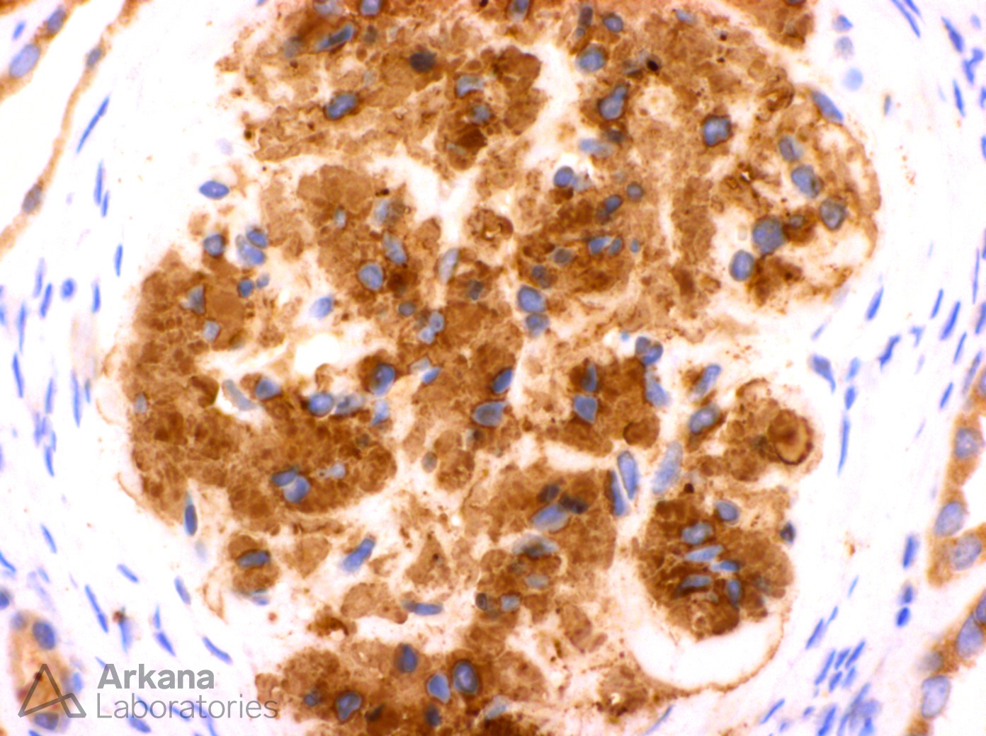 DNAJB9 staining for fibrillary glomerulopathy