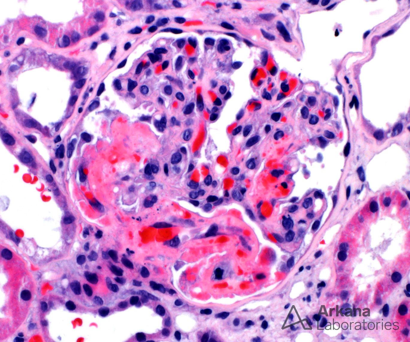Postpartum Hemolytic Uremic Syndrome (HUS)