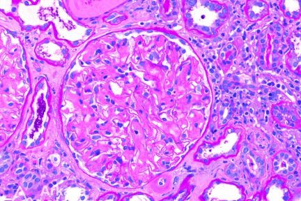 lambda light chain restricted renal amyloidosis