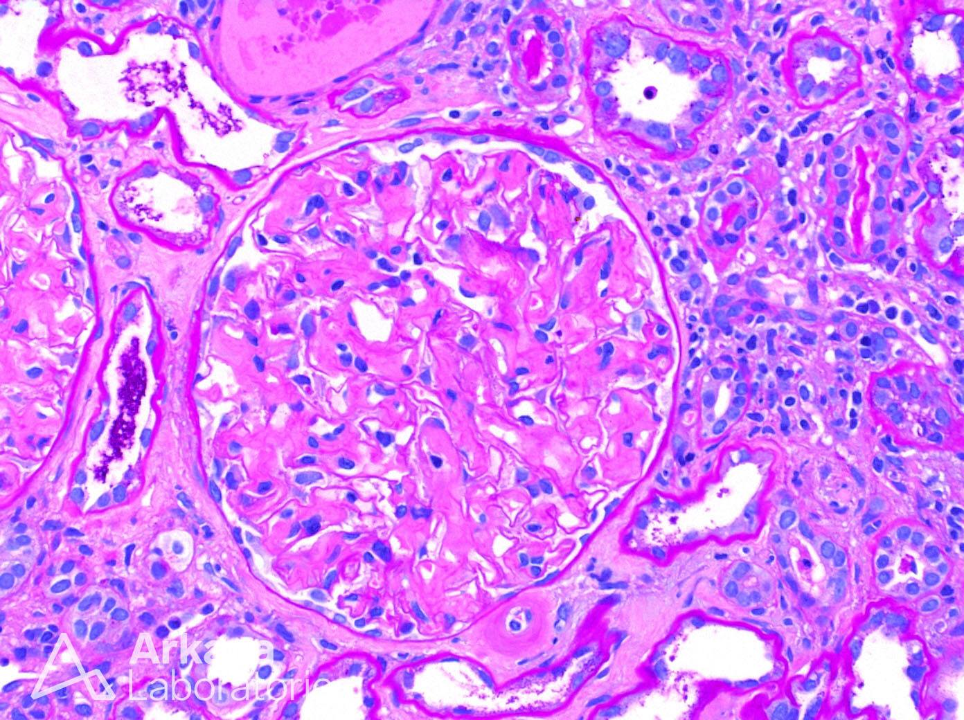 lambda light chain restricted renal amyloidosis