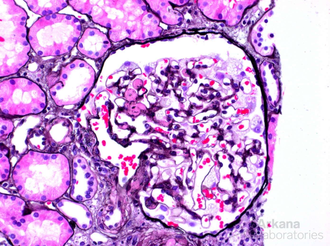 Fabry disease