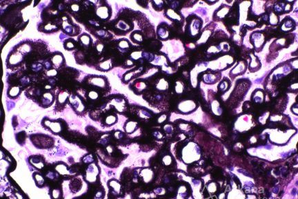 Membranous Glomerulopathy