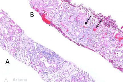 A Tale of Two Cores, cores, arkana laboratories, renal pathology