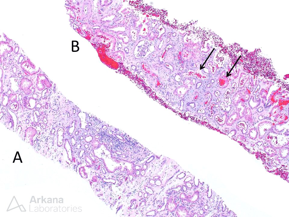 A Tale of Two Cores, cores, arkana laboratories, renal pathology