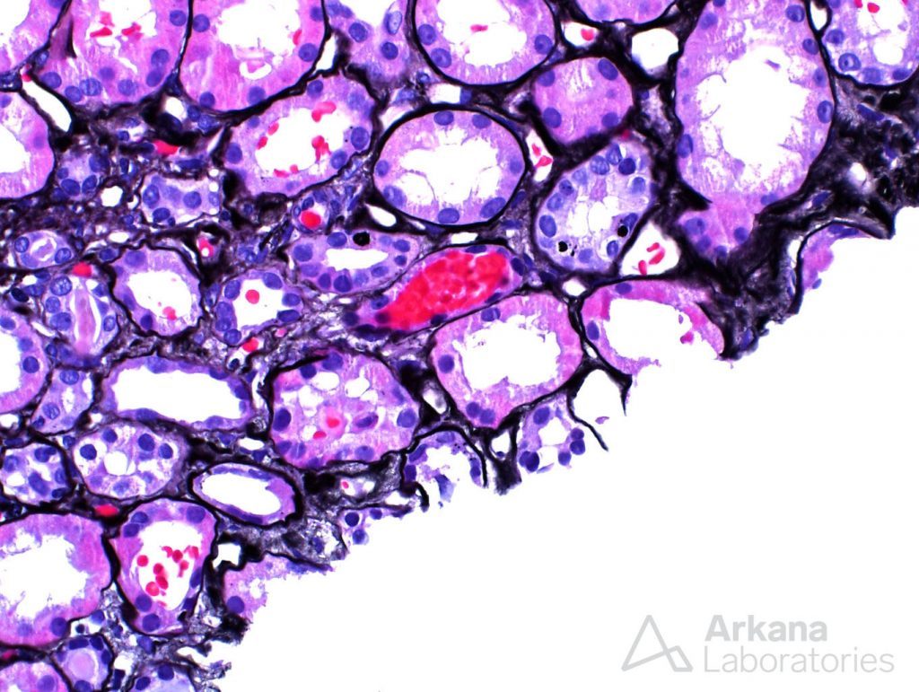 Interstitial inflammation, biopsy, interstitial nephritis, tubules, intratubular red blood cell casts, arkana laboratories