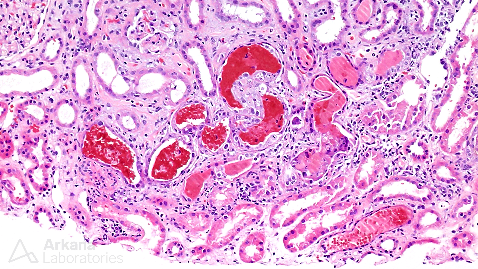 ANCA-Associated Glomerulonephritis, art of medicine