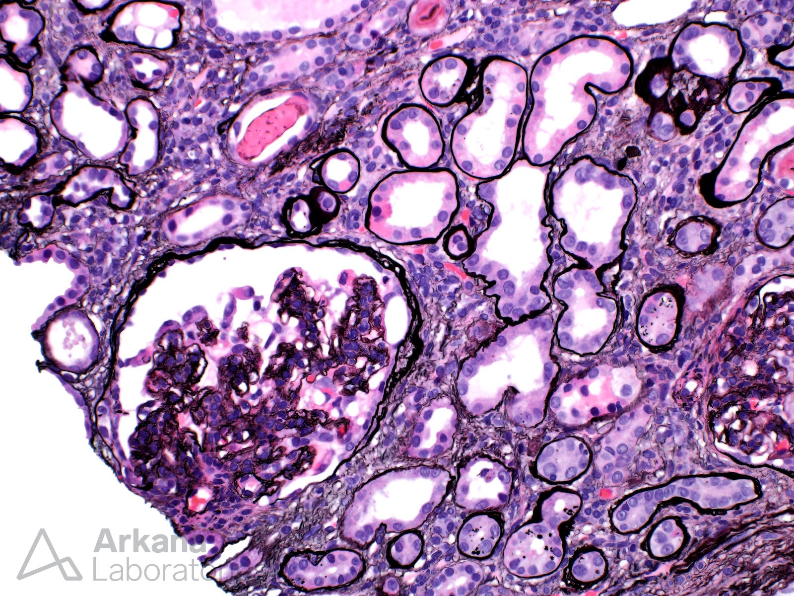 HIV-associated nephropathy (HIVAN)