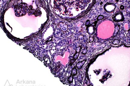 HIV-associated nephropathy (HIVAN)