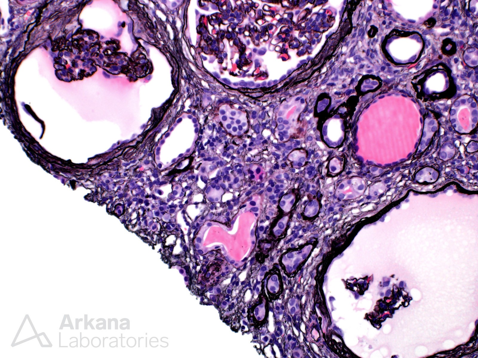 HIV-associated nephropathy (HIVAN)