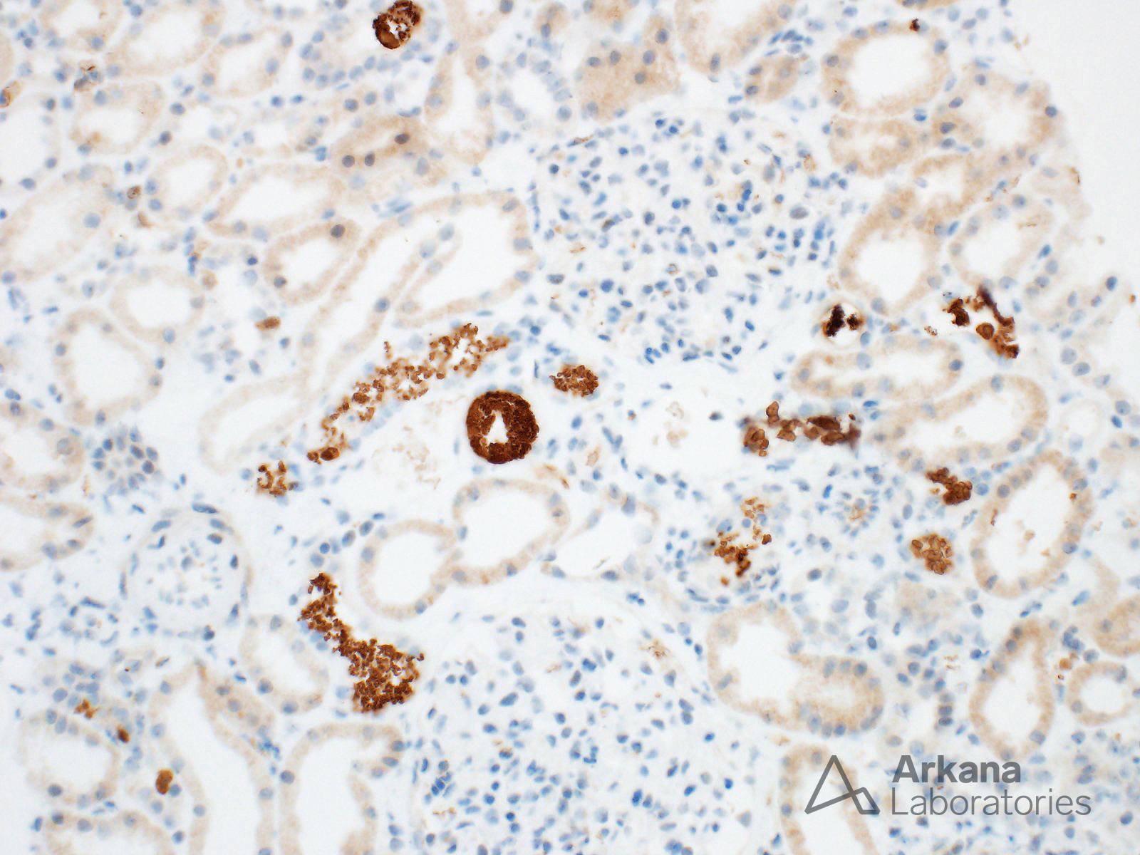 morphologic lesions present in hemoglobin cast nephropathy are indistinguishable from myoglobin cast nephropathy