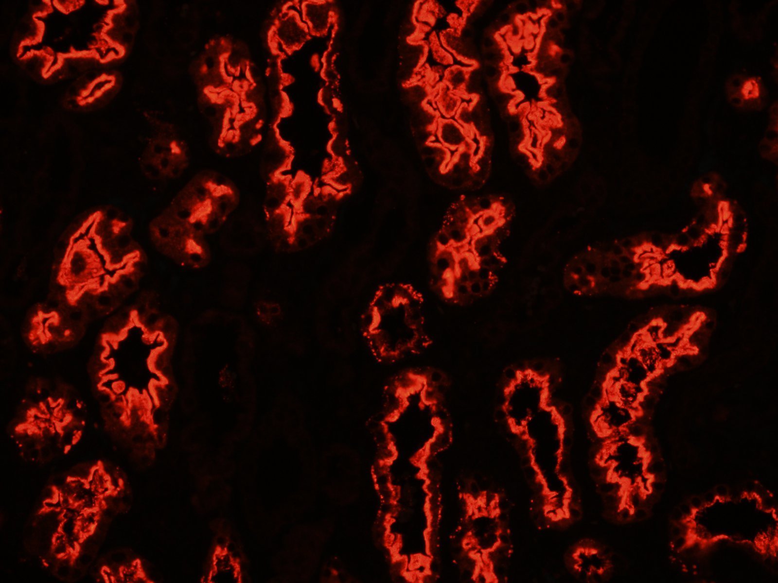 Anti-Brush Border Antibody Disease (ABBA), Arkana laboratories, Diagnose This!