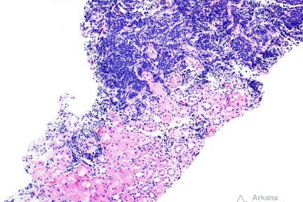 Lymphocytic Leukemia (CLL and SLL)