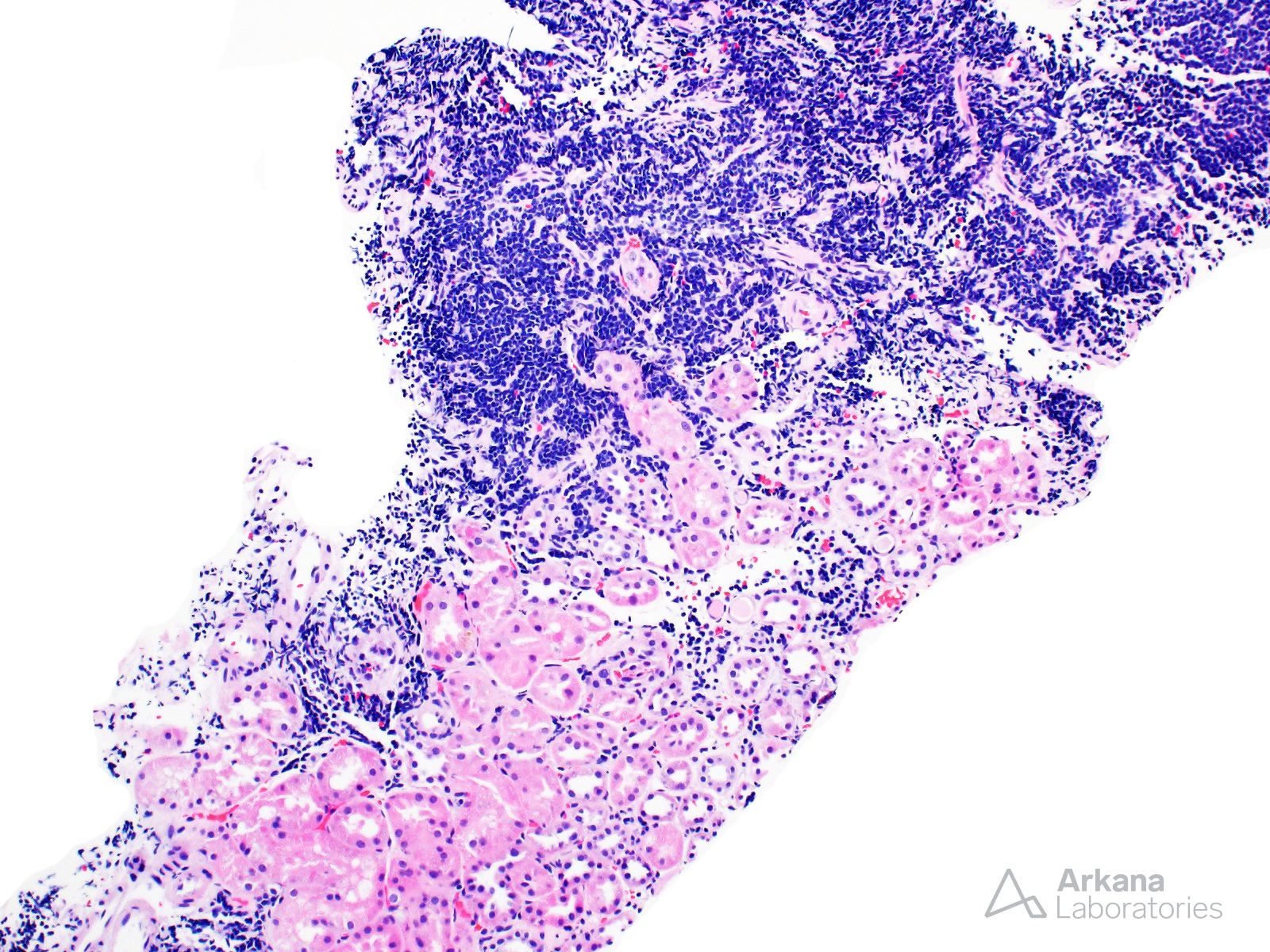 Lymphocytic Leukemia (CLL and SLL)